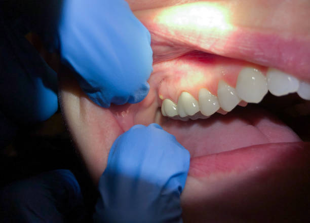 Best Emergency Tooth Extraction in Pecan Plantation, TX